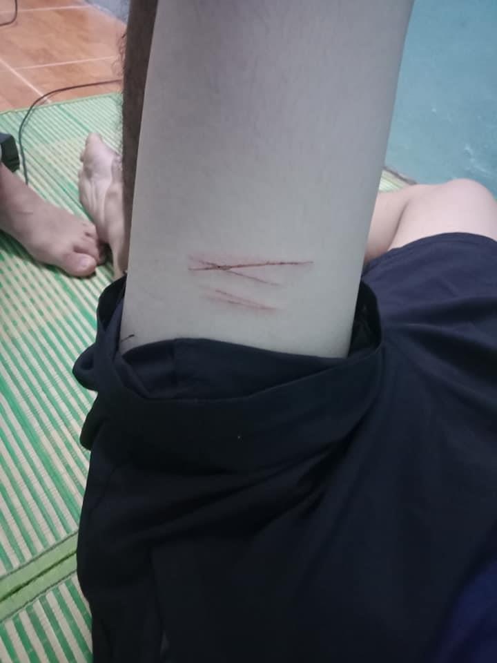 Nam sinh bị cướp dùng dao lam rạch chân ảnh 2 Nam sinh bi cuop dung dao lam rach chan anh 2