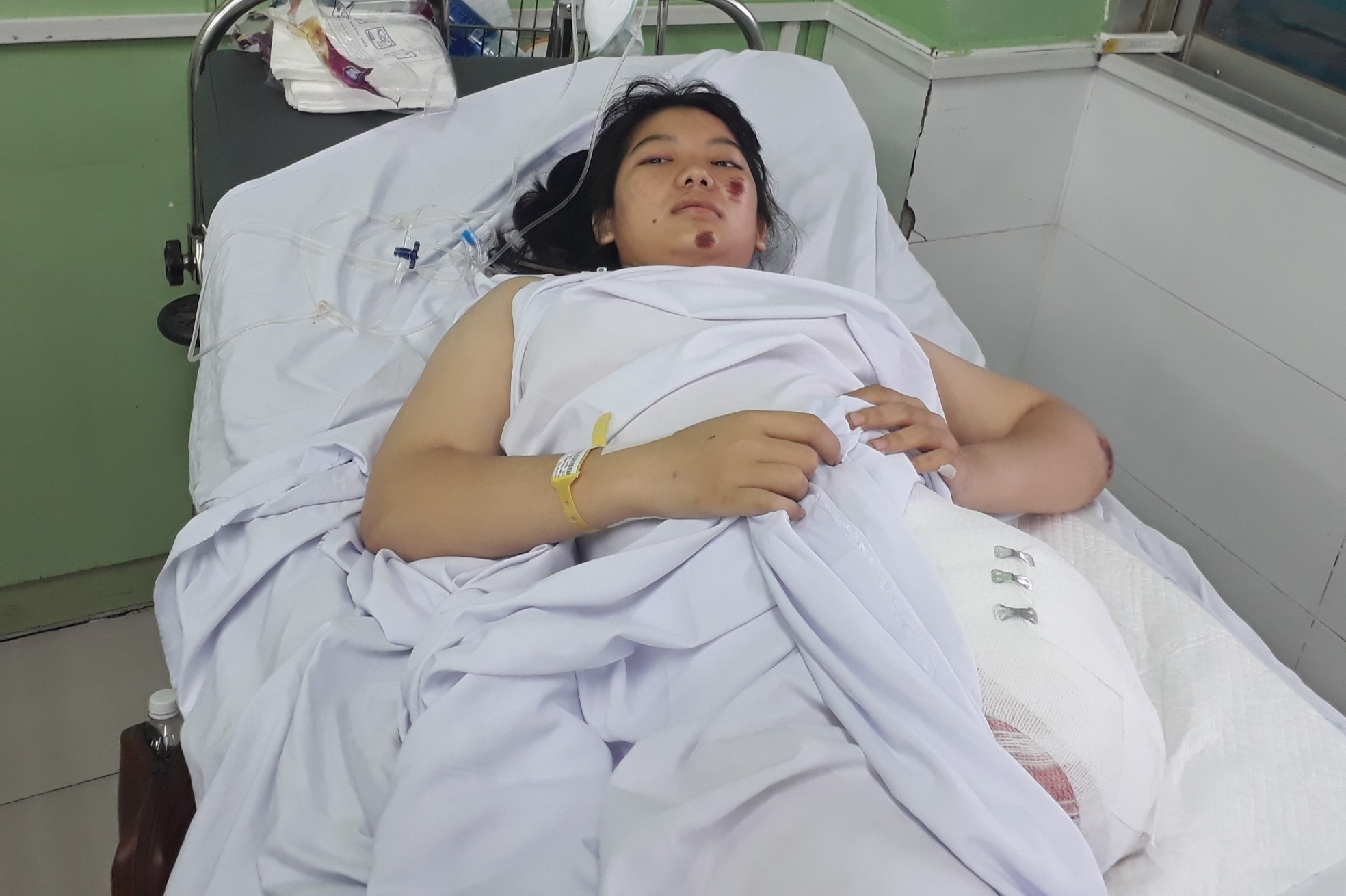 Nu sinh 16 tuoi mat chan trai vi tai nan tren duong di hoc ve hinh anh