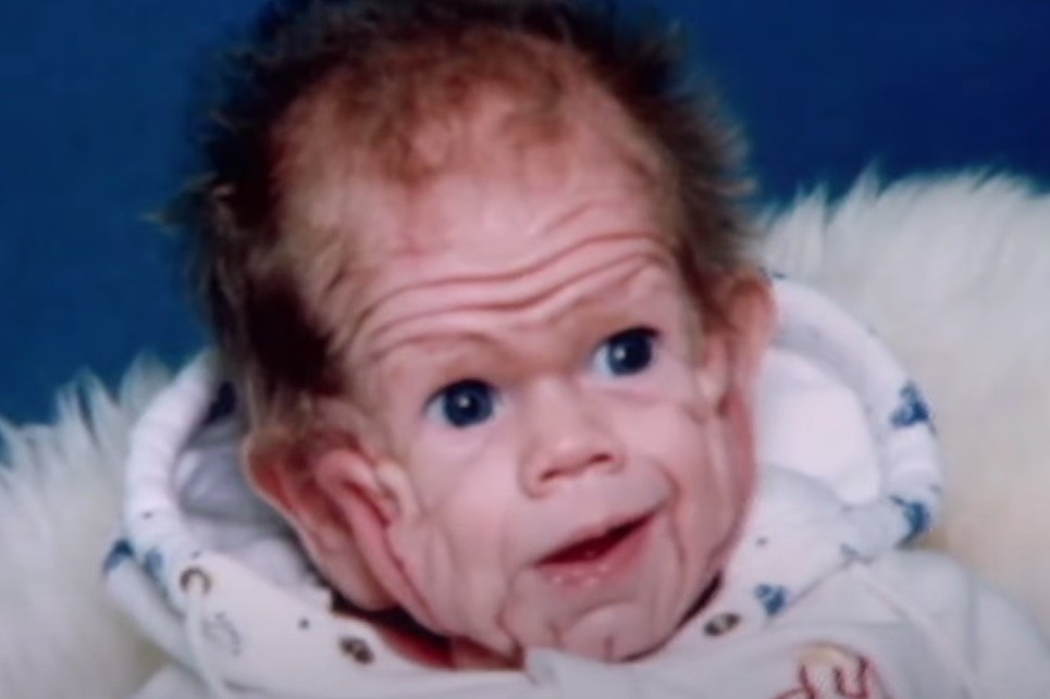 Cuoc song cua be trai co lan da nhan nheo nhat the gioi hinh anh