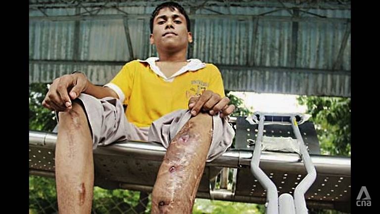 phẫu thuật kéo dài chân ảnh 4 phau thuat keo dai chan anh 4