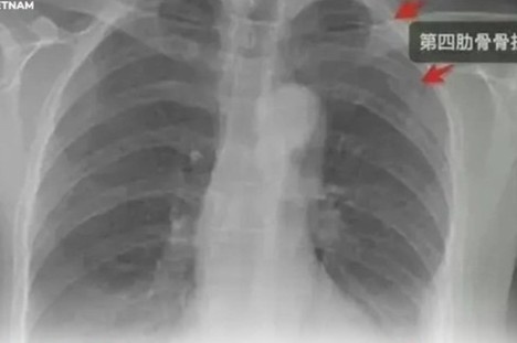 Bi dong nghiep nam om chat, co gai gay 3 xuong suon o Trung Quoc hinh anh