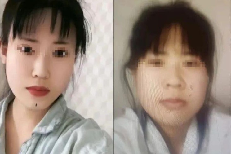 Co gai tu tu ngay khi xuat vien vi nghi phau thuat tham my hong hinh anh