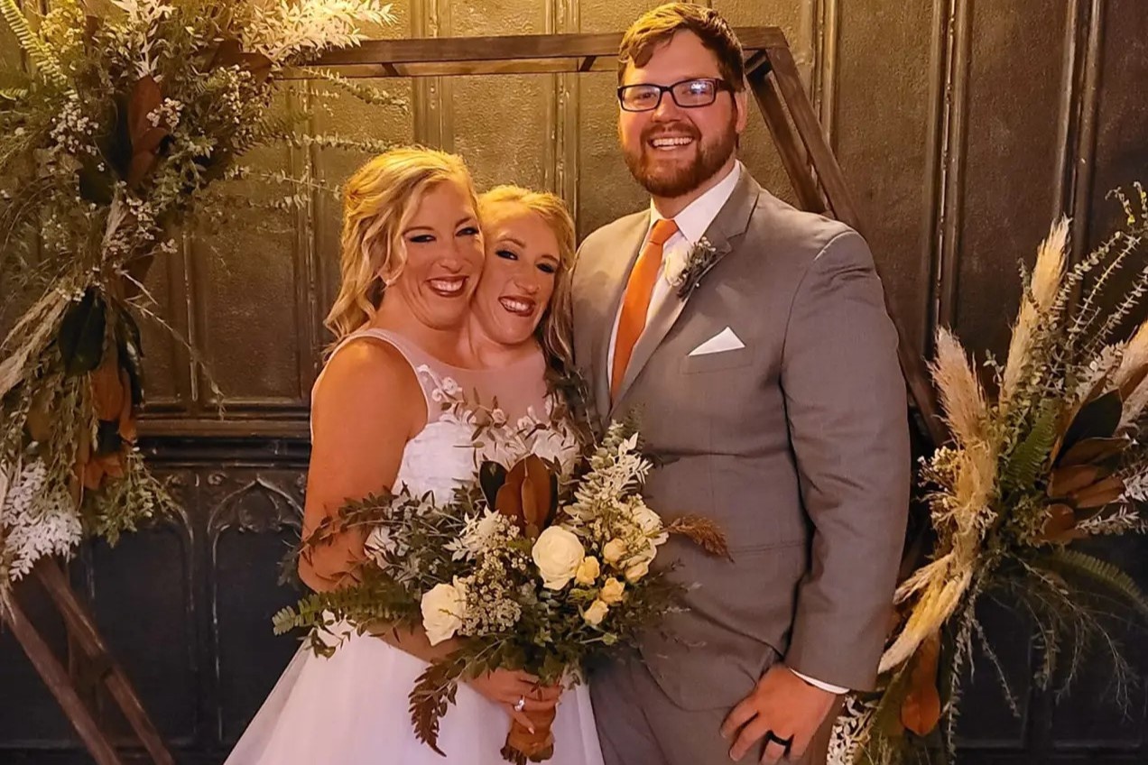 Nhung buc anh lan dau cong bo ve hon le cua cap song sinh dinh lien hinh anh