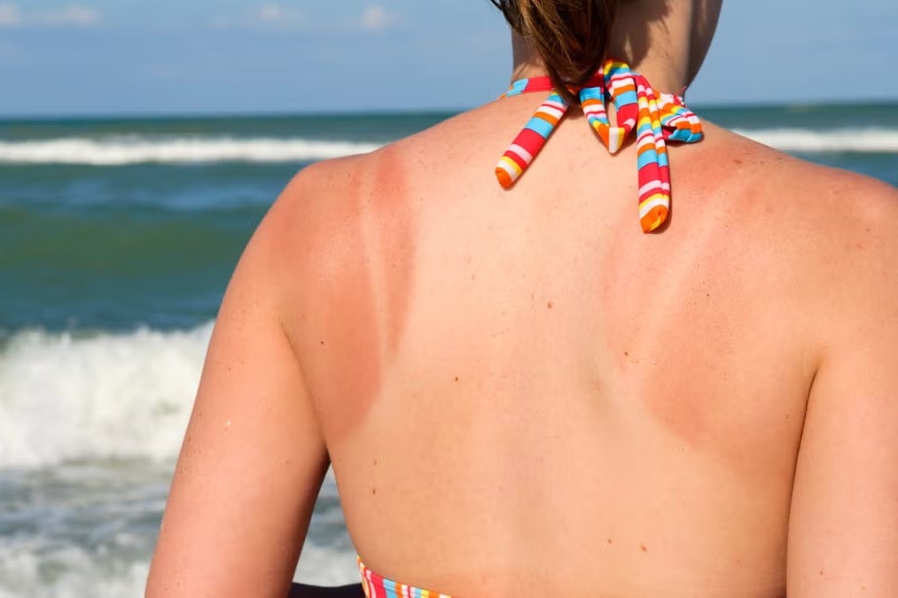 Cach lam diu lan da khi bi bong nang hinh anh