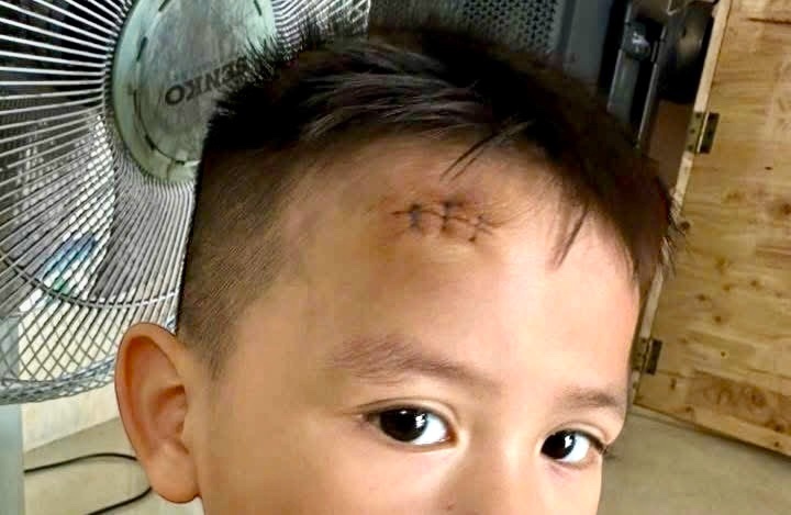 'Khoi nghi he' nga gay chan, sut dau khau 3 mui khien bo me khoc thet hinh anh