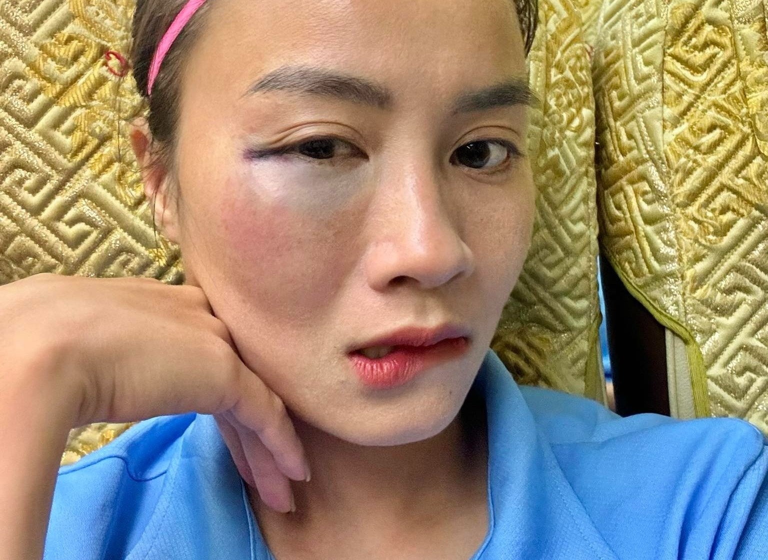 Guong mat sung vu cua hot girl bong da sau va cham hinh anh