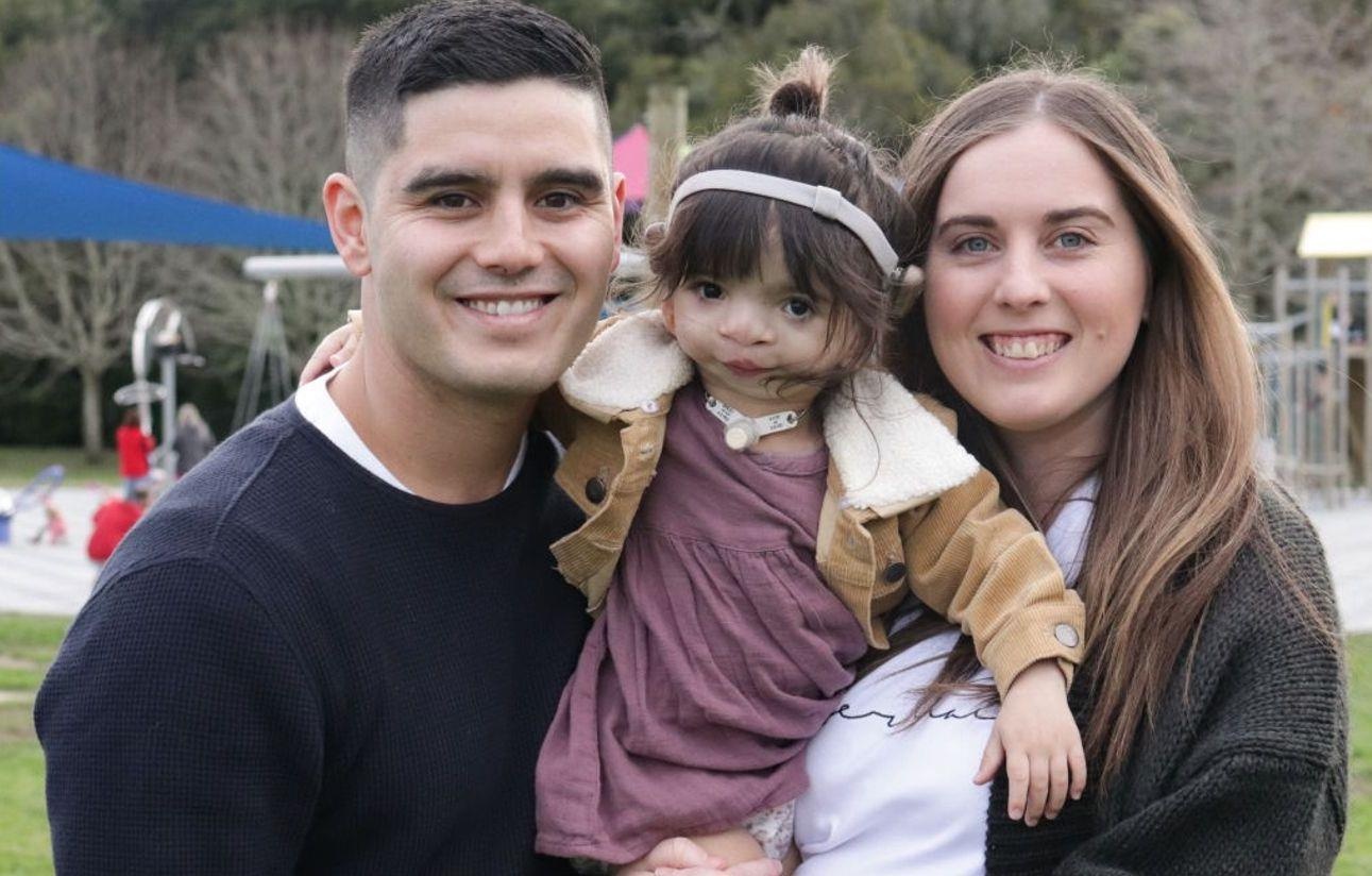 Co be mang khuon mat bien dang vi di tat bam sinh hinh anh