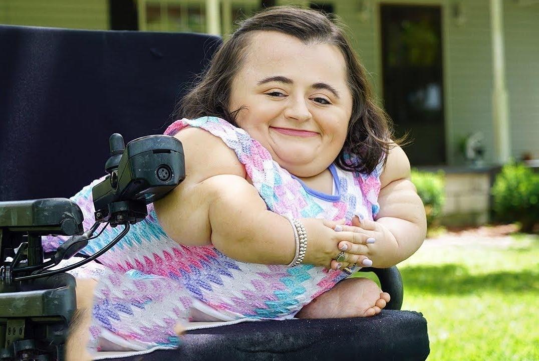 Co gai mac benh xuong gion den muc co the gay neu hat hoi hinh anh