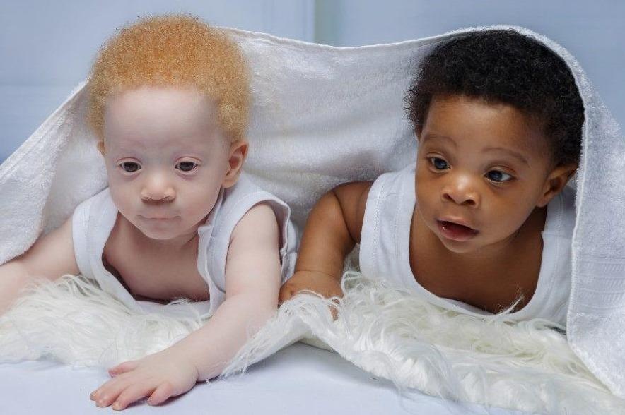 Cap sinh doi mot da den, mot da trang hiem gap hinh anh