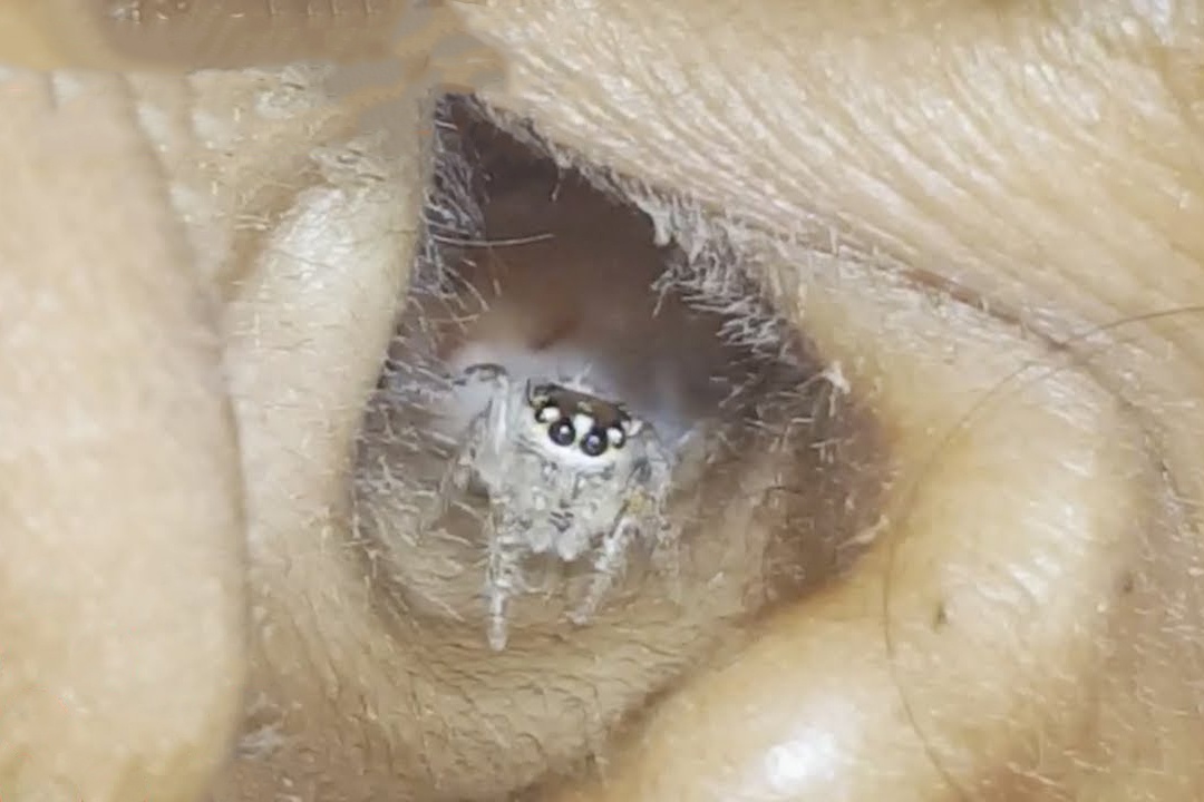 Nhen mac ket ben trong tai nguoi phu nu hinh anh