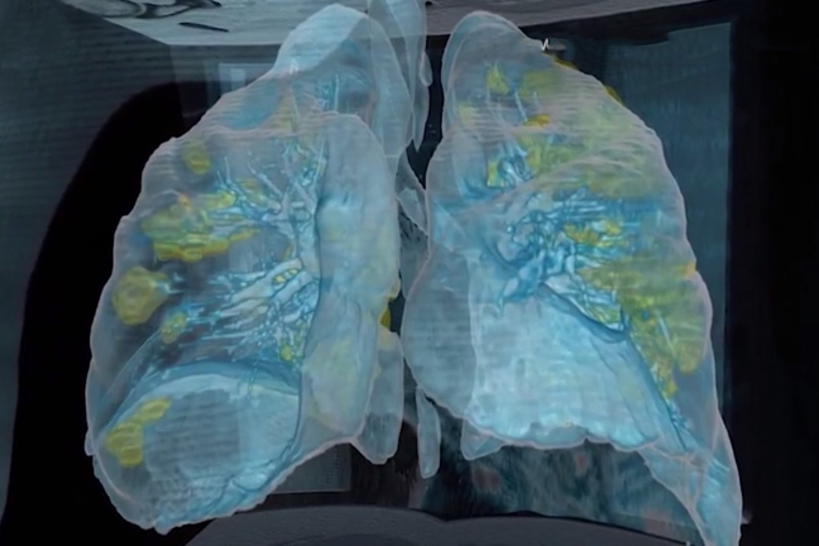 Hinh anh phoi cua nguoi mac Covid-19 hinh anh