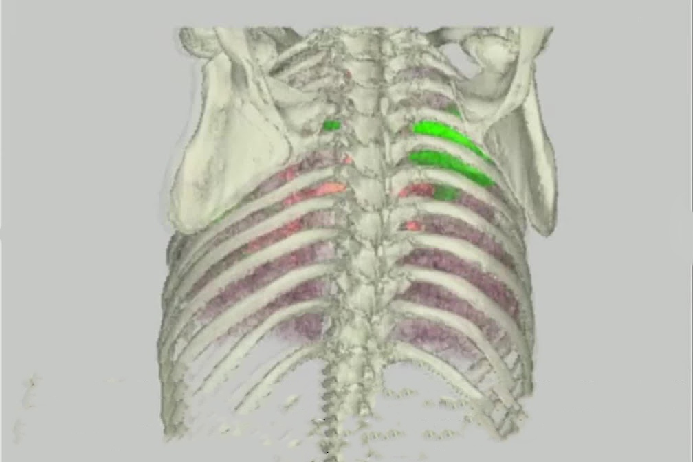 Hinh anh phoi 3D cua nguoi mac Covid-19 hinh anh