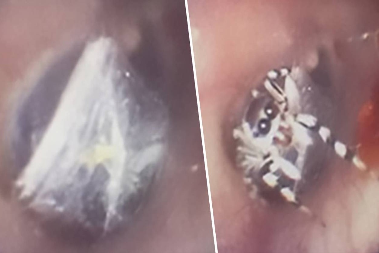 Nhen giang to trong tai nguoi phu nu hinh anh