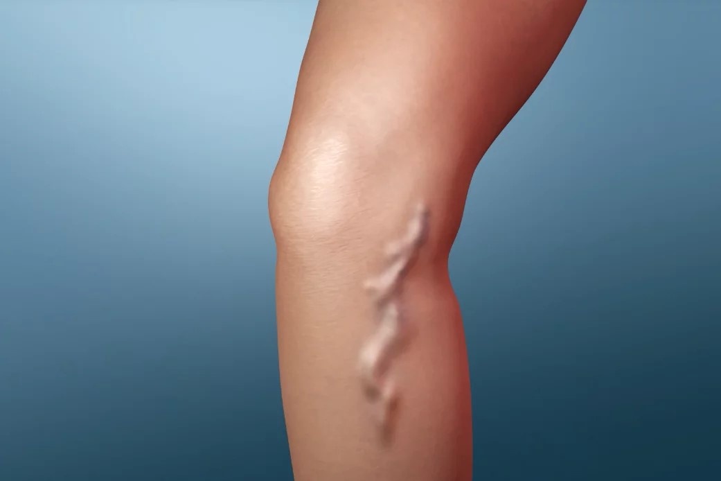 Nguyen nhan gay suy gian tinh mach chan hinh anh