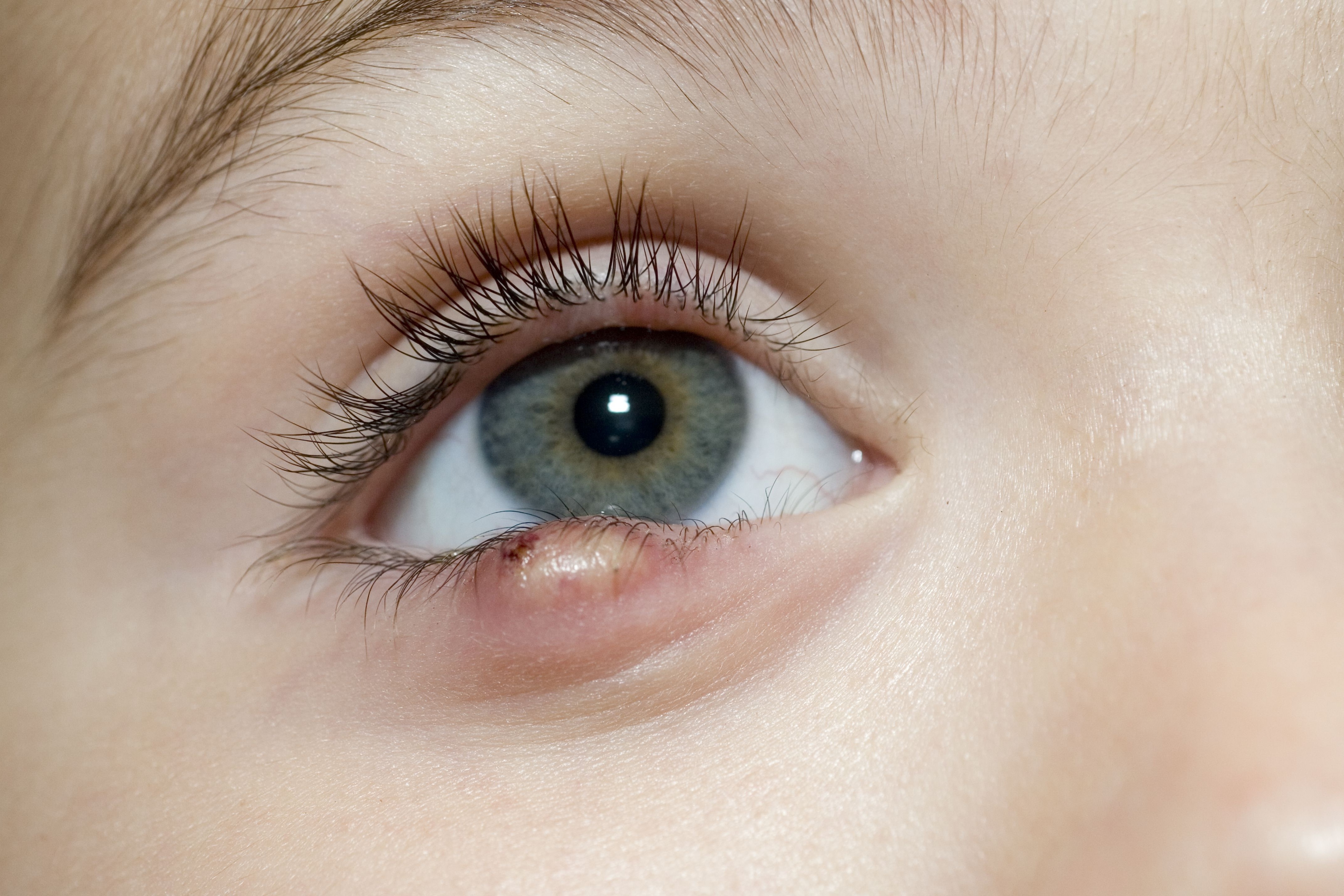 Nguyen nhan gay leo mat hinh anh