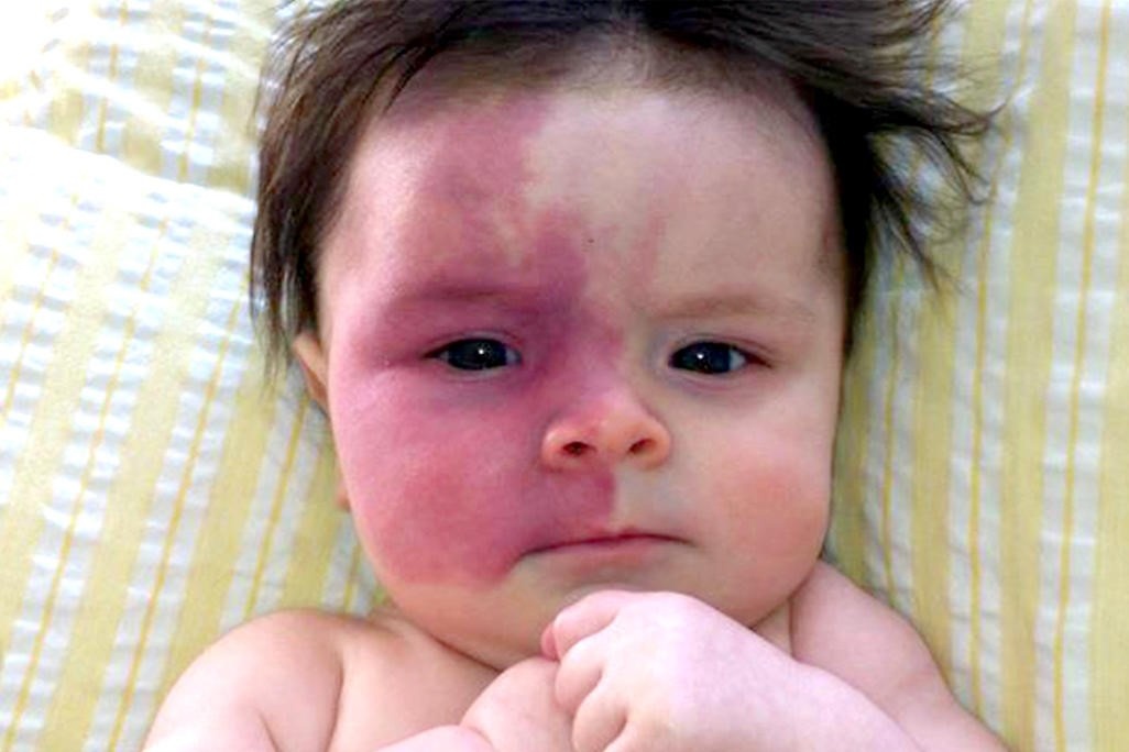 Vi sao chung ta co vet bot? hinh anh