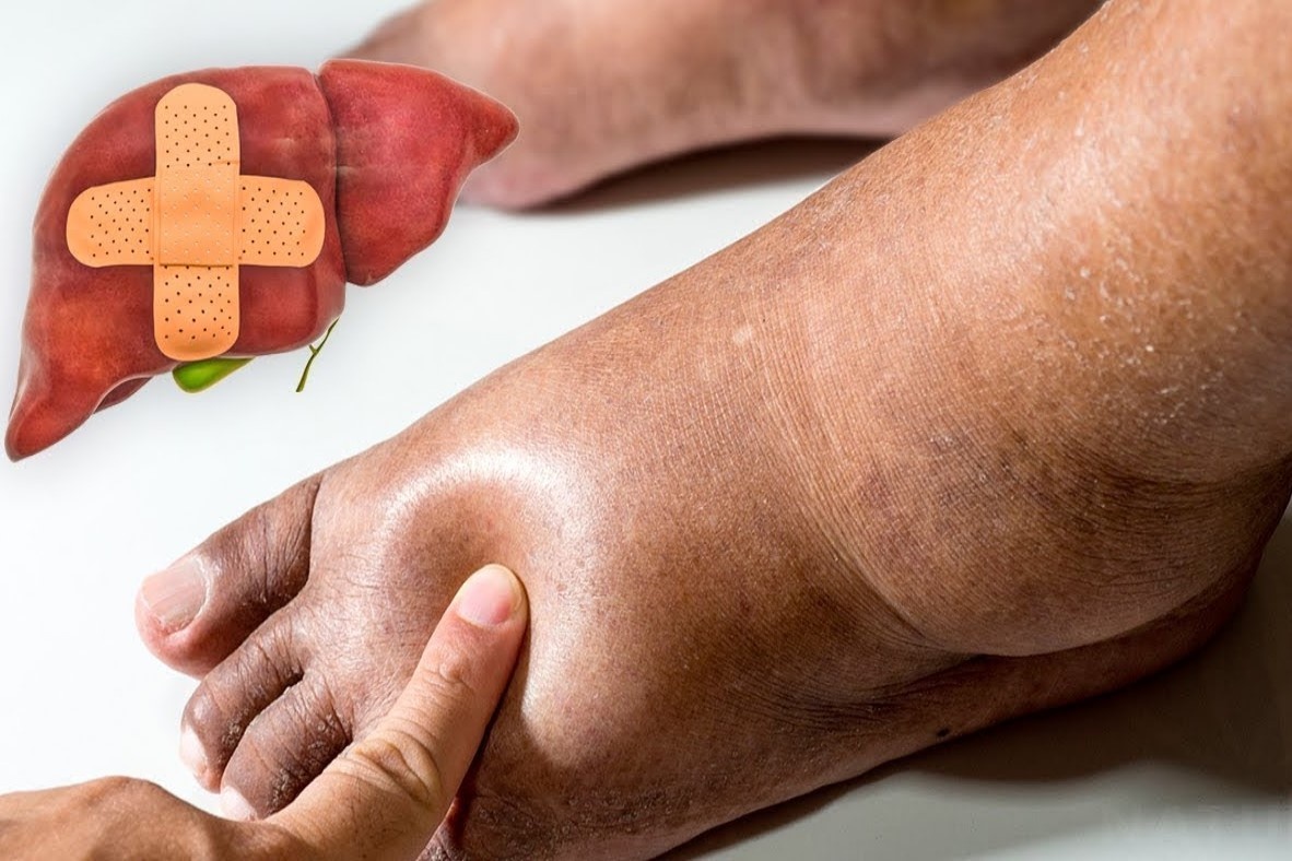 5 dau hieu o ban chan canh bao suc khoe cua gan hinh anh