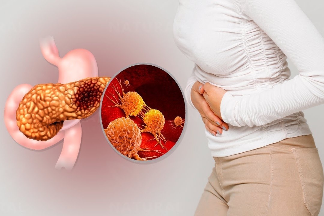 Dau hieu nhan biet benh ung thu tuyen tuy hinh anh