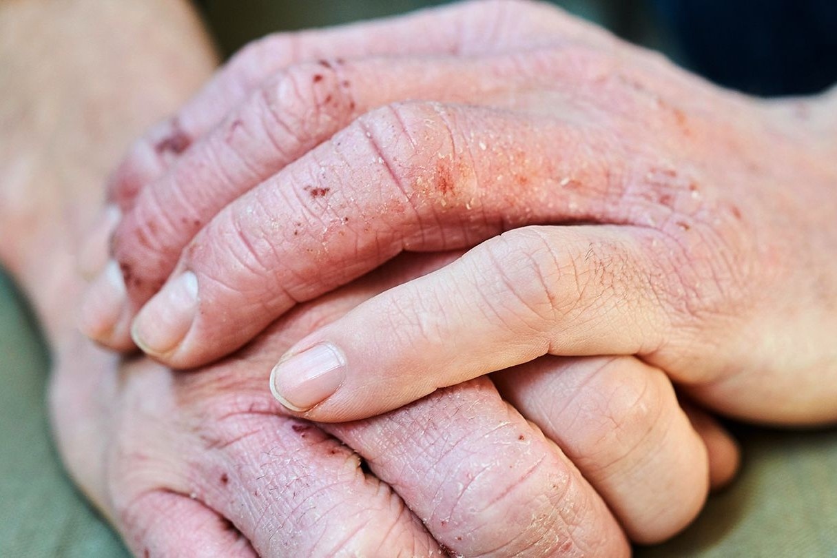 7 dau hieu tren ban tay tiet lo cac van de suc khoe hinh anh