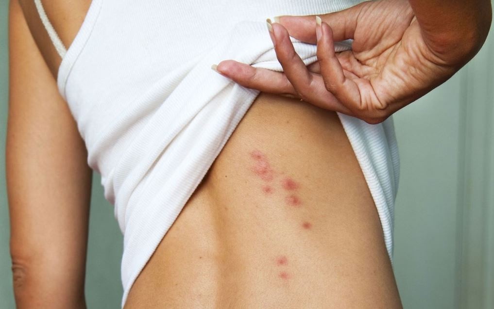 Cach xu ly vet con trung dot hieu qua hinh anh