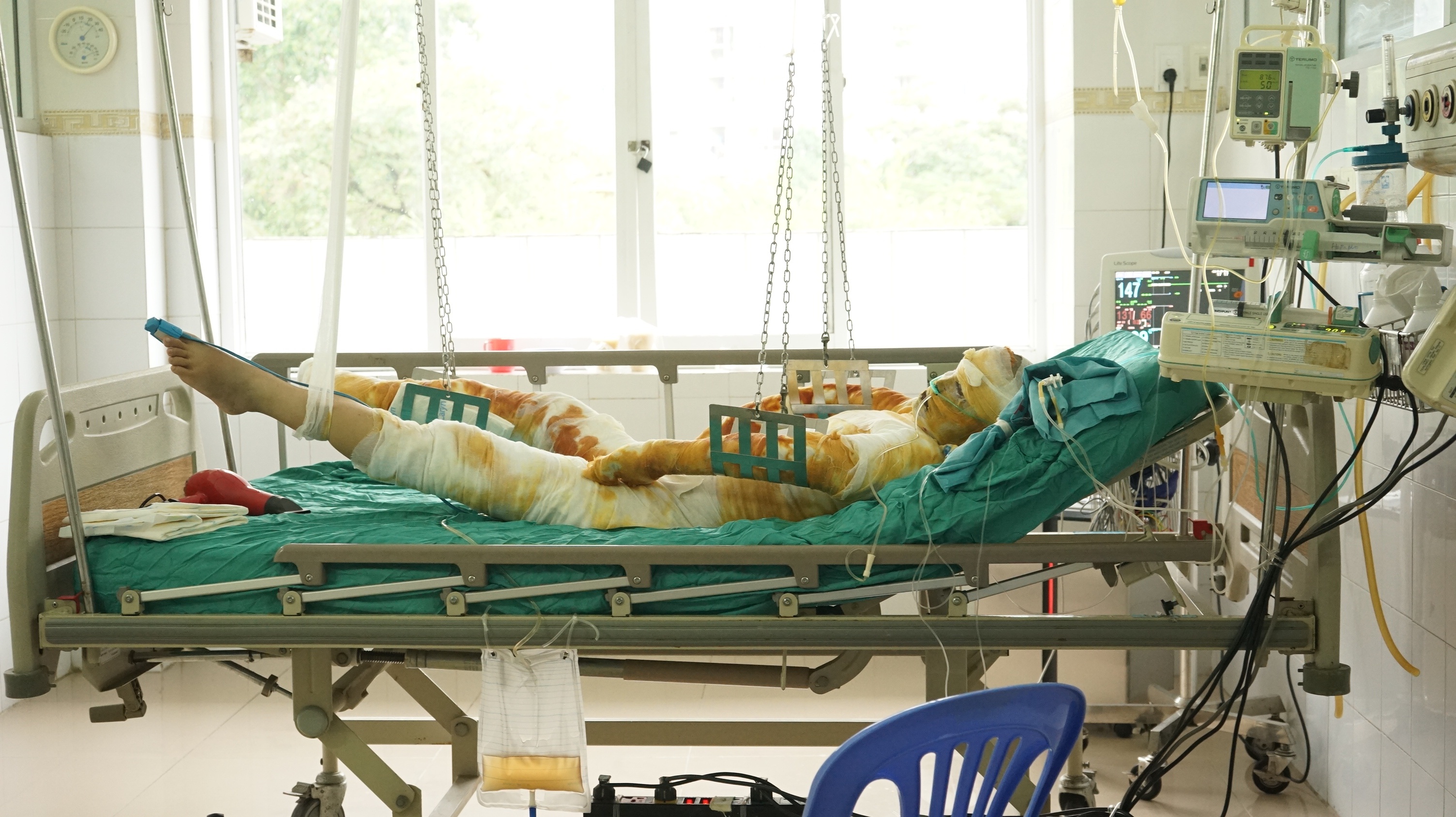 co gai bi bong toan than qua doi anh 1