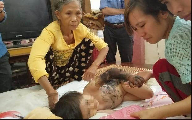 Be gai 3 tuoi bi bong kin lung hinh anh