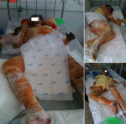 Bố ghép da cho con bị bỏng ảnh 2 Bo ghep da cho con bi bong anh 2