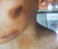 cậu bé 12 tuổi bị mẹ kế đánh nhập viện ảnh 2 cau be 12 tuoi bi me ke danh nhap vien anh 2
