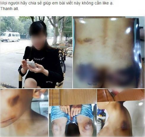 cậu bé 12 tuổi bị mẹ kế đánh nhập viện ảnh 1 cau be 12 tuoi bi me ke danh nhap vien anh 1