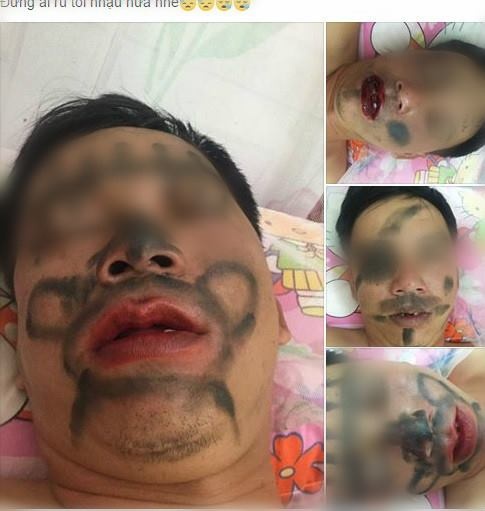 trung tri chong say ruou anh 1