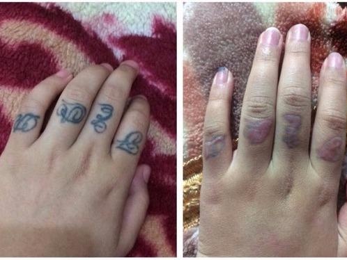 Co gai xam hinh tu lop 8 va vet seo di theo ca cuoc doi hinh anh