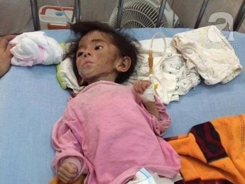 Be Lao Cai suy dinh duong khi moi duoc dua di chua tri hinh anh