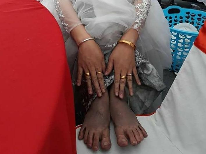 Cau chuyen dang sau doi chan lam lem cua co dau Quang Ninh hinh anh