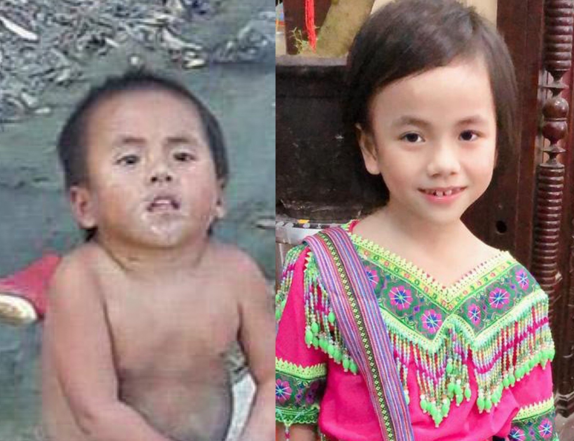 Em be Muong Lat bi liet 2 chan cuoi rang ro trong hinh anh moi nhat hinh anh