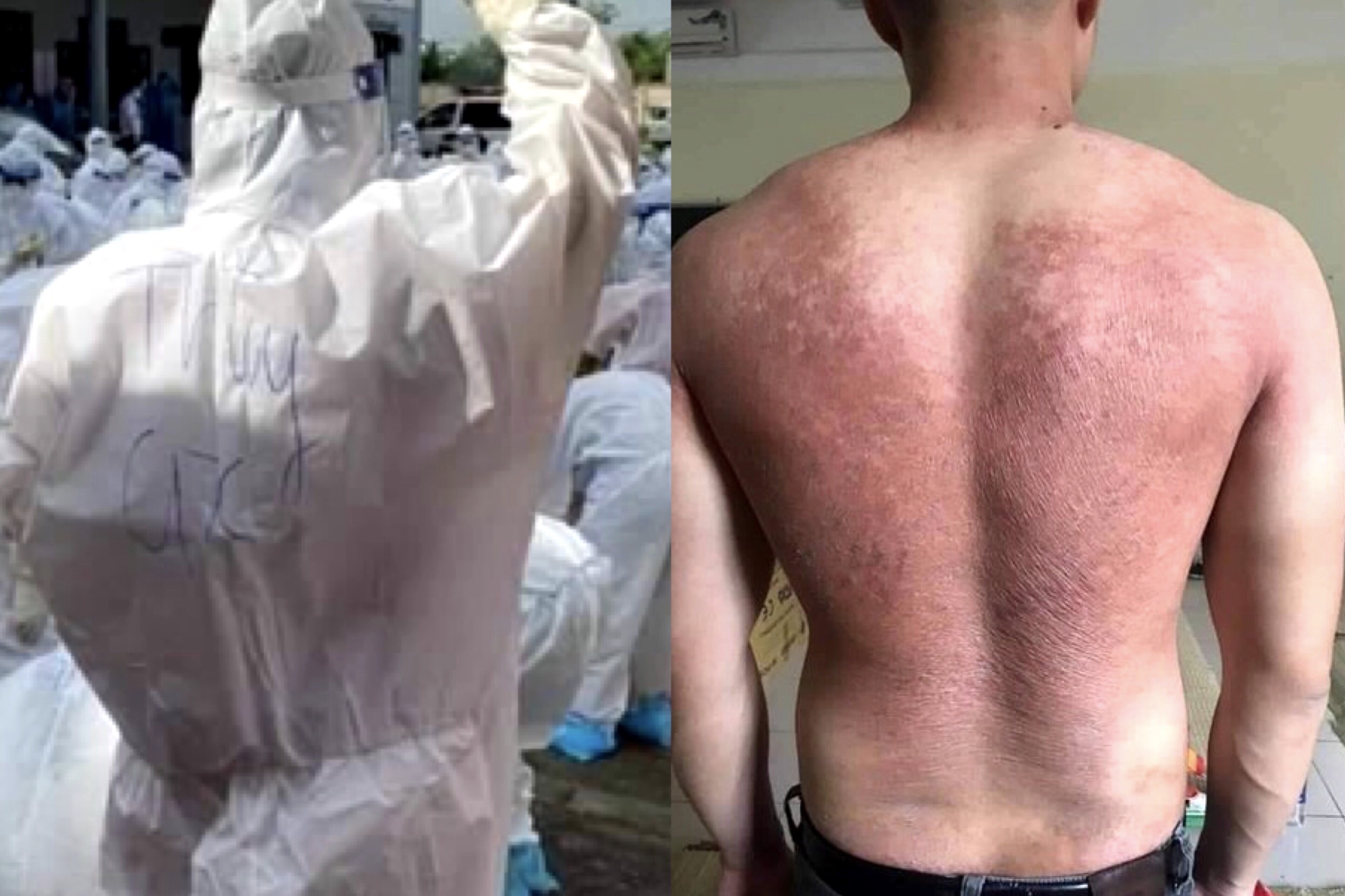 Lung nhan vien y te o Bac Giang phong rop vi mac do bao ho kin mit hinh anh