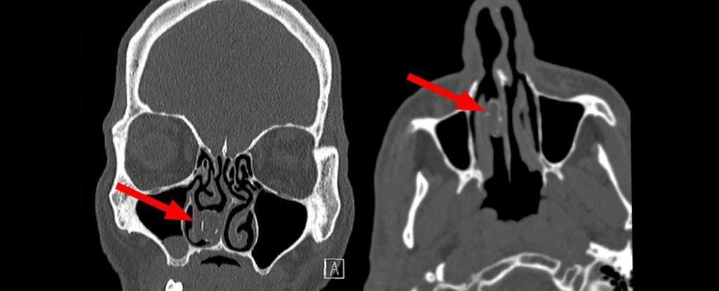 Goi can sa ket trong mui anh 1