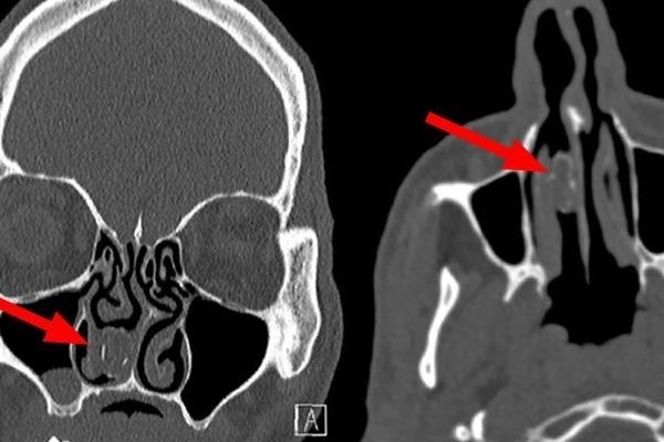 Goi can sa ket trong mui nguoi dan ong suot 18 nam hinh anh