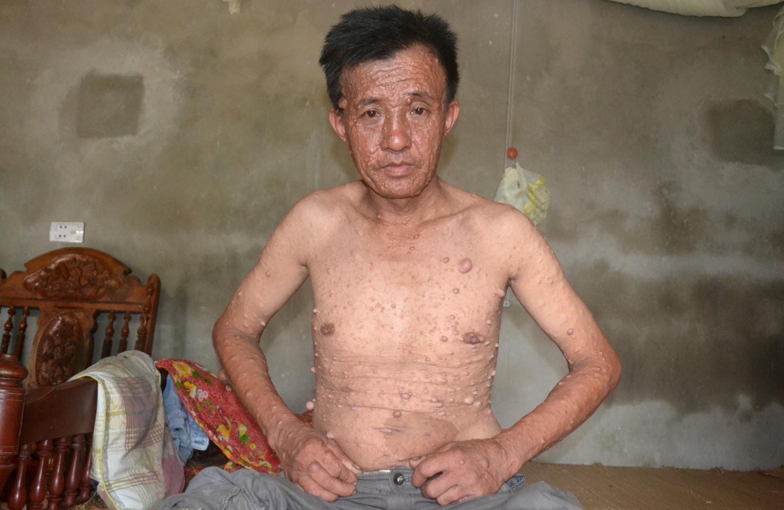 Căn bệnh lạ khiến toàn thân ông Thành nổi chi chít khối u thịt thừa. Ảnh: Nguyễn Dương.