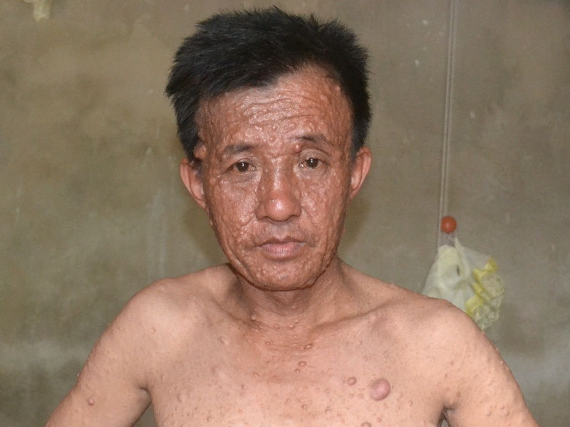 Nguoi dan ong moc hang tram khoi u khap toan than hinh anh