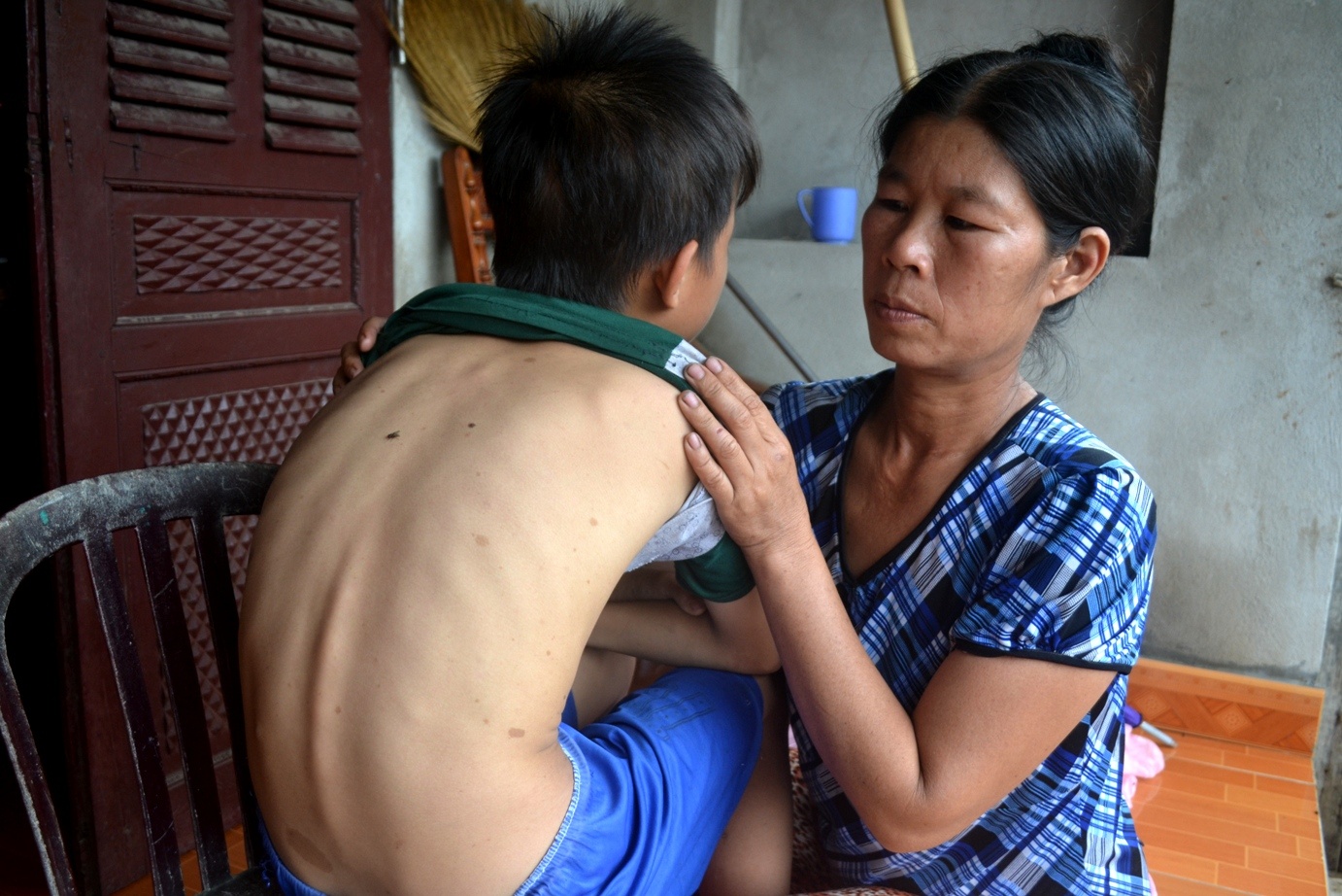 Cháu Nguyễn Văn Bốn đang có dấu hiệu mắc bệnh nổi khối u thịt thừa như bố mình. Ảnh: Nguyễn Dương.