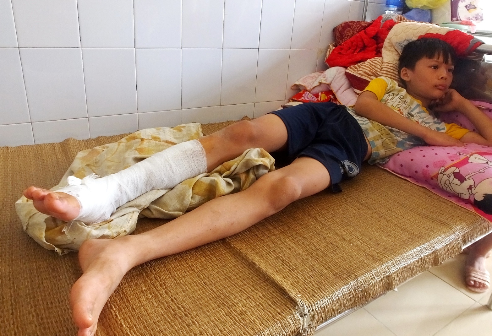 Một cháu nhỏ bị bỏng đang điều trị tại bệnh viện. Ảnh: N. D.