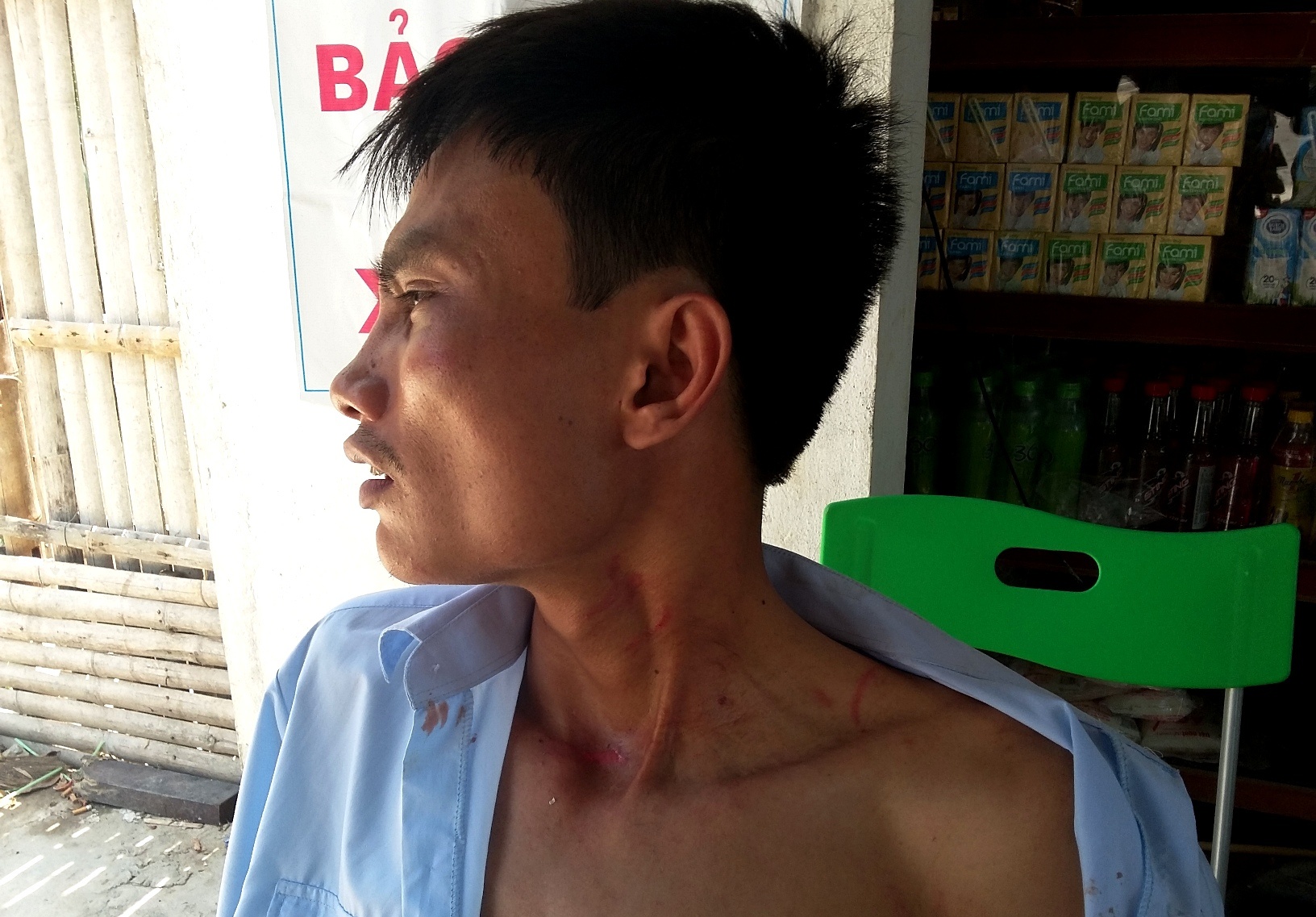 Tài xế Bùi Đình Tĩnh bị đánh dẫn đến xây xát vùng cổ, tay và lưng... Ảnh: Nguyễn Dương.