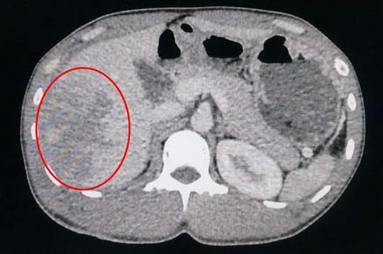 Nguoi dan ong vo gan vi banh xe tai no hoi hinh anh