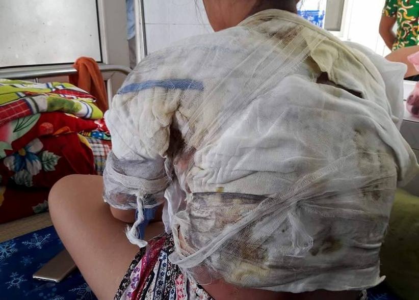 Bat giam ga chong doi nuoc soi len nguoi vo hinh anh