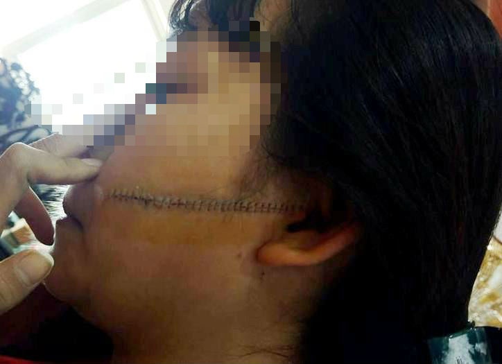 nữ sinh bị đâm rách mặt ảnh 1 nu sinh bi dam rach mat anh 1