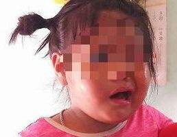 Nghi van co giao mam non danh be 3 tuoi liet day than kinh, meo mom hinh anh