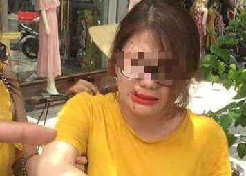 Bị thương sau tiếng nổ ảnh 2 Bi thuong sau tieng no anh 2