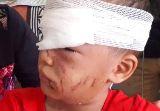 Be trai 6 tuoi o Thanh Hoa bi cho nha can rach mat hinh anh