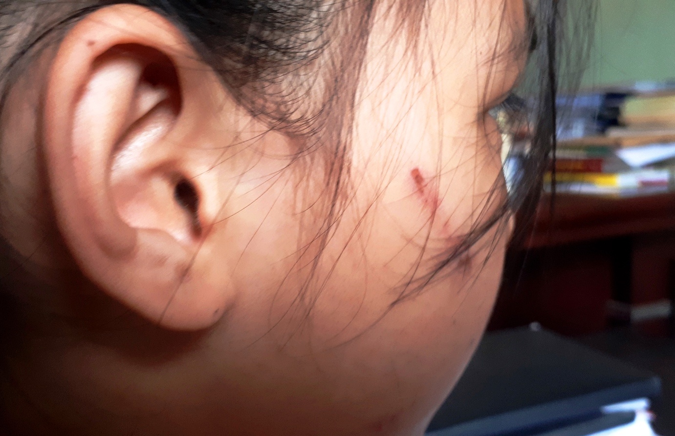 Be gai bat on tam ly sau khi bi cha danh bam nguoi hinh anh