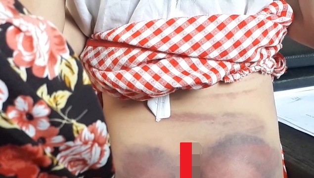 bé gái bị cha đánh bầm tím người ảnh 2 be gai bi cha danh bam tim nguoi anh 2